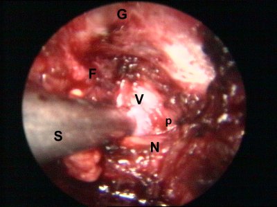 dasselbe endoskopisch: Perforationsstelle ...